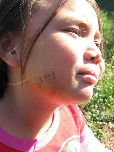 How to treat a dog bite Meinhart Smith Manning