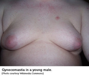 gynecomastia - male breasts