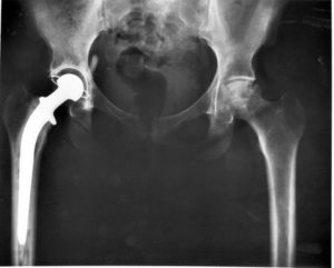 stryker-hip-replacement